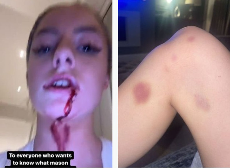 Harriet birti myndir á Instagram af áverkum sínum.