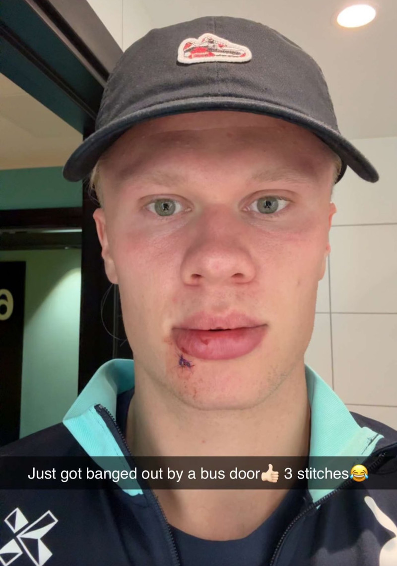 Haaland birti mynd af sér eftir slysið á Snapchat.